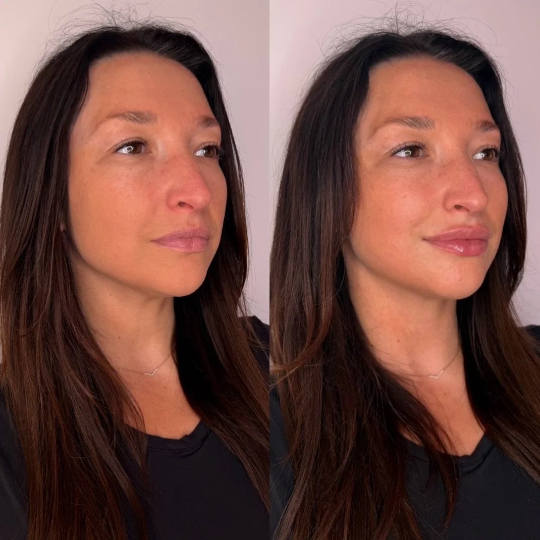 when the assignment is a little more definition through the cupid&rsquo;s bow + hydration and just a touch of plump to already fuller lips&hellip; say less.

we used 0.35 mL of Kysse here. this is immediately after, so there&rsquo;s some swelling to 