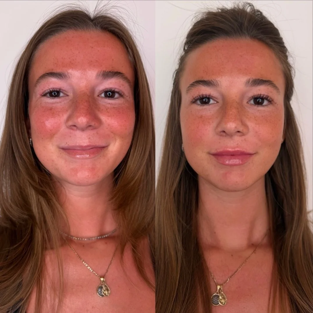 Building naturally smaller lips takes patience, precision, and a thoughtful approach.

These beautiful lips were completed over two separate sessions, gradually building shape, definition, and just the right amount of volume.

The goal was never larg
