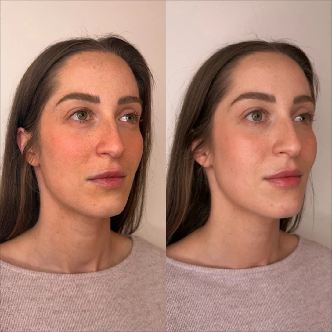 there&rsquo;s something so beautiful about lip filler when it&rsquo;s done right. a little more definition, a slight plump, and just enough enhancement to make the lips look soft, balanced, and naturally beautiful.

the goal was never to make them lo