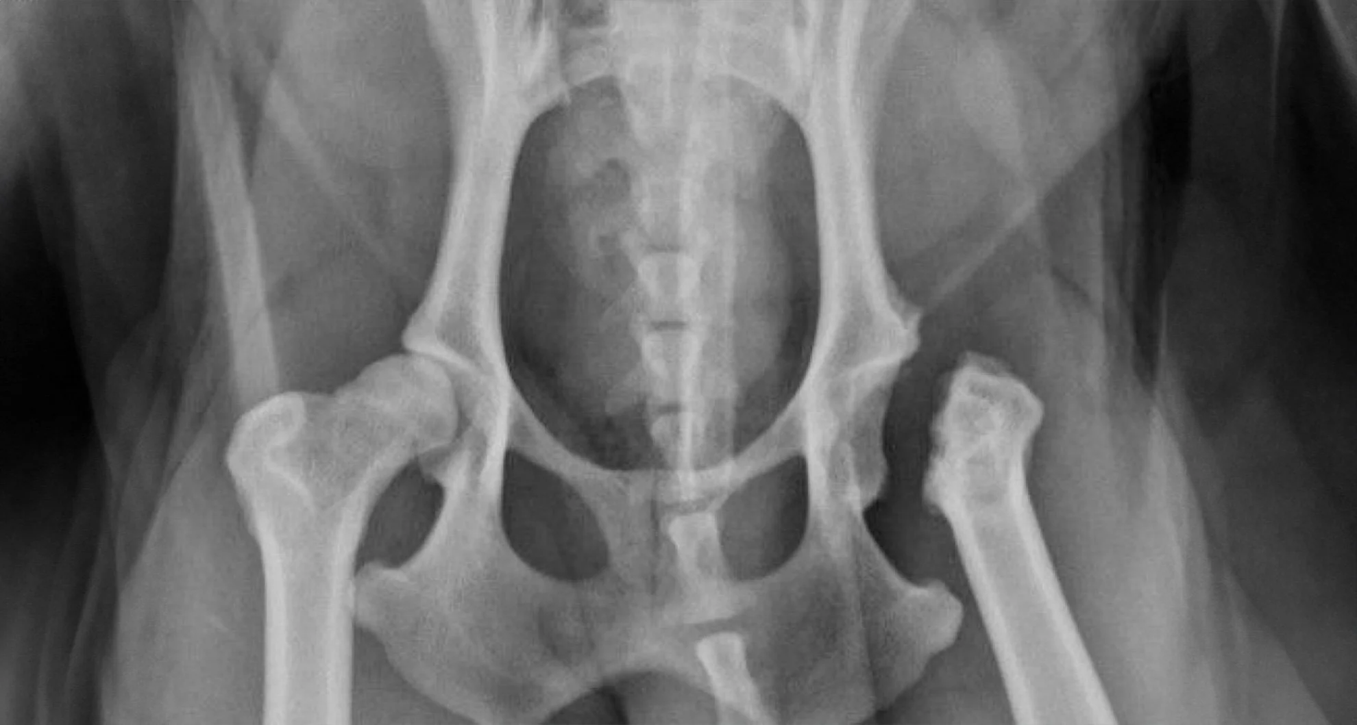 Postoperative canine hip X-ray after femoral head ostectomy surgery