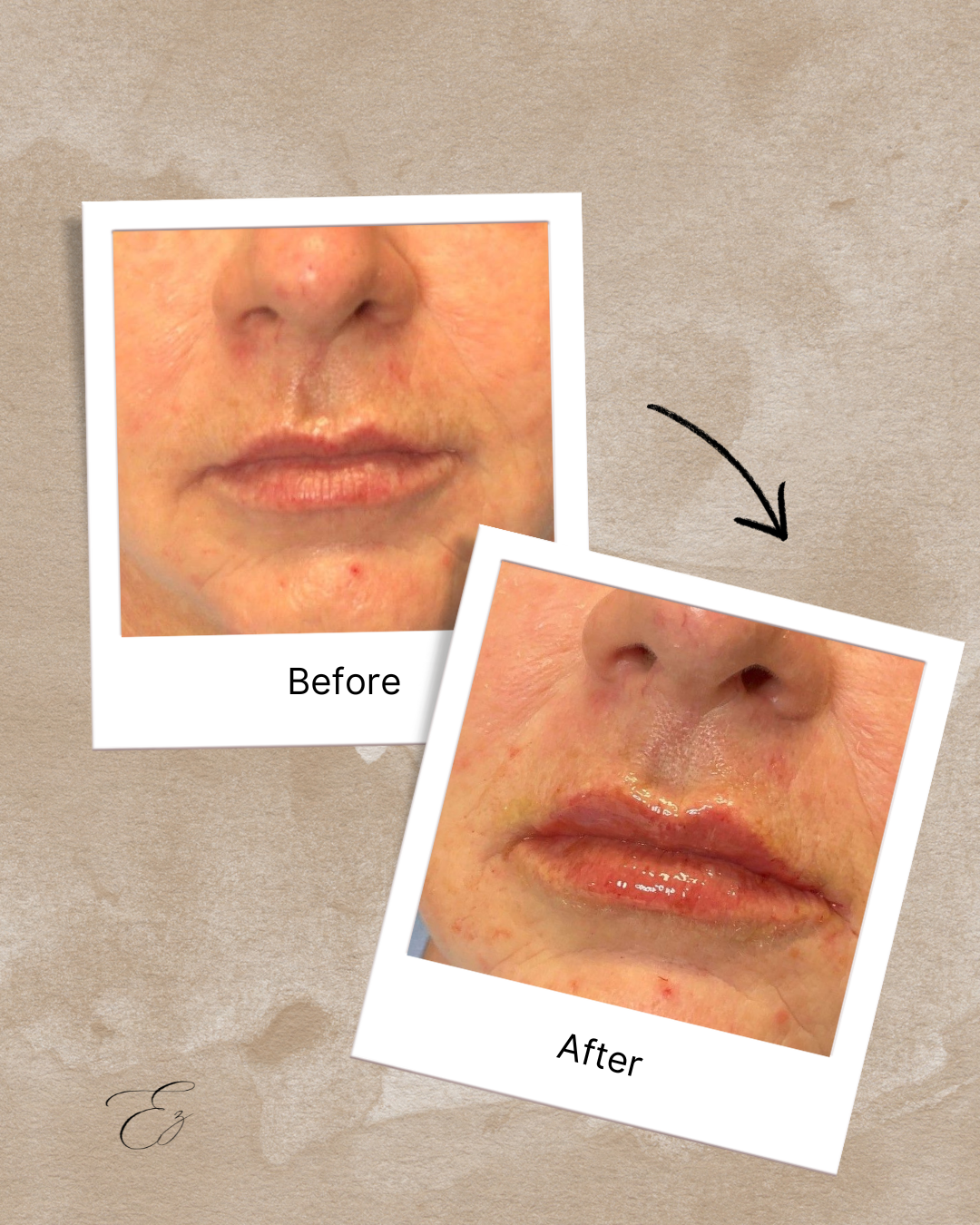 Choosing the Right Provider for Injectables: Why Quality, Proportion, and Expertise Matter