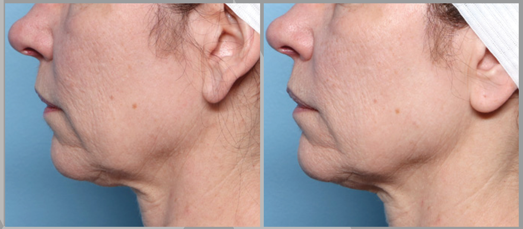 What Is XERF Skin Tightening? The New RF Treatment in Fort Worth