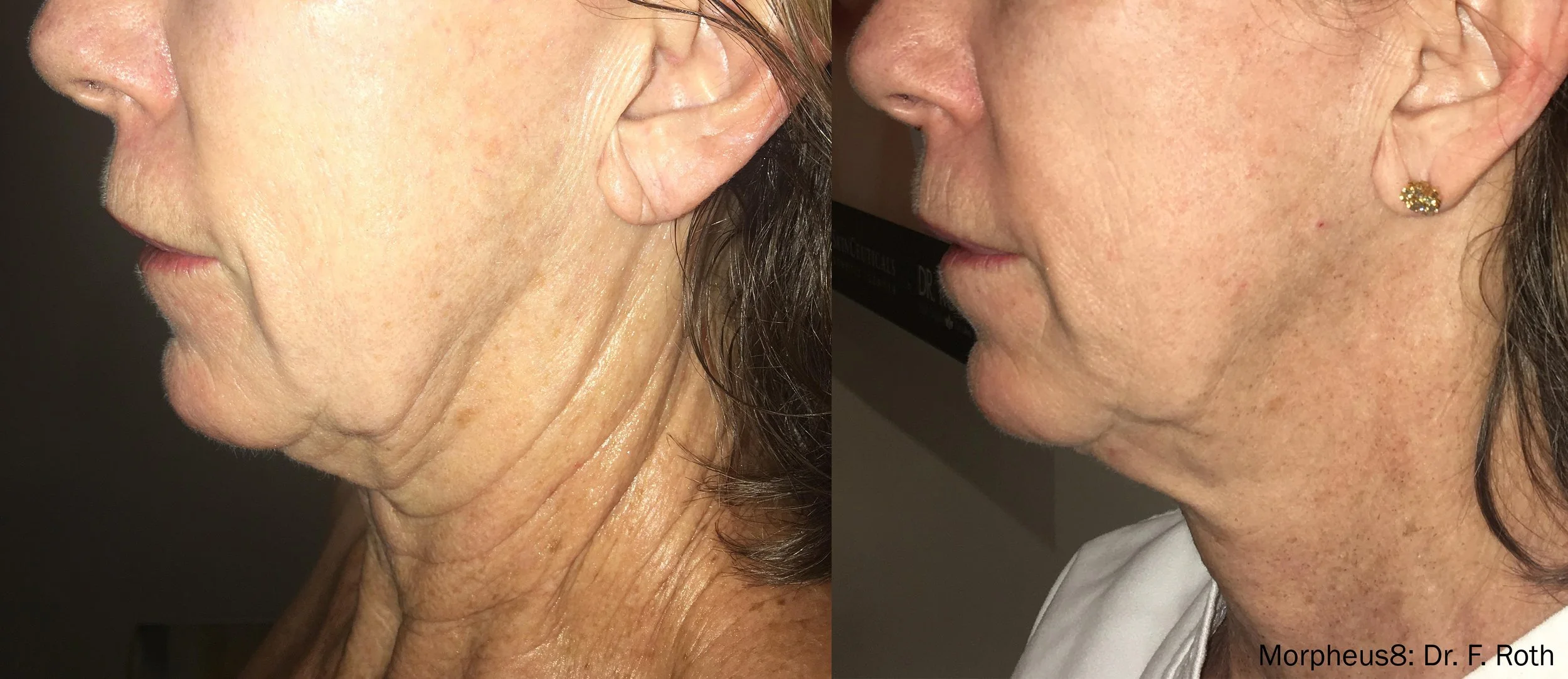 Side-by-side comparison of a woman's lower face and neck before and after Morpheus8 radiofrequency microneedling by InMode treatment, showing reduced wrinkles and tighter skin.