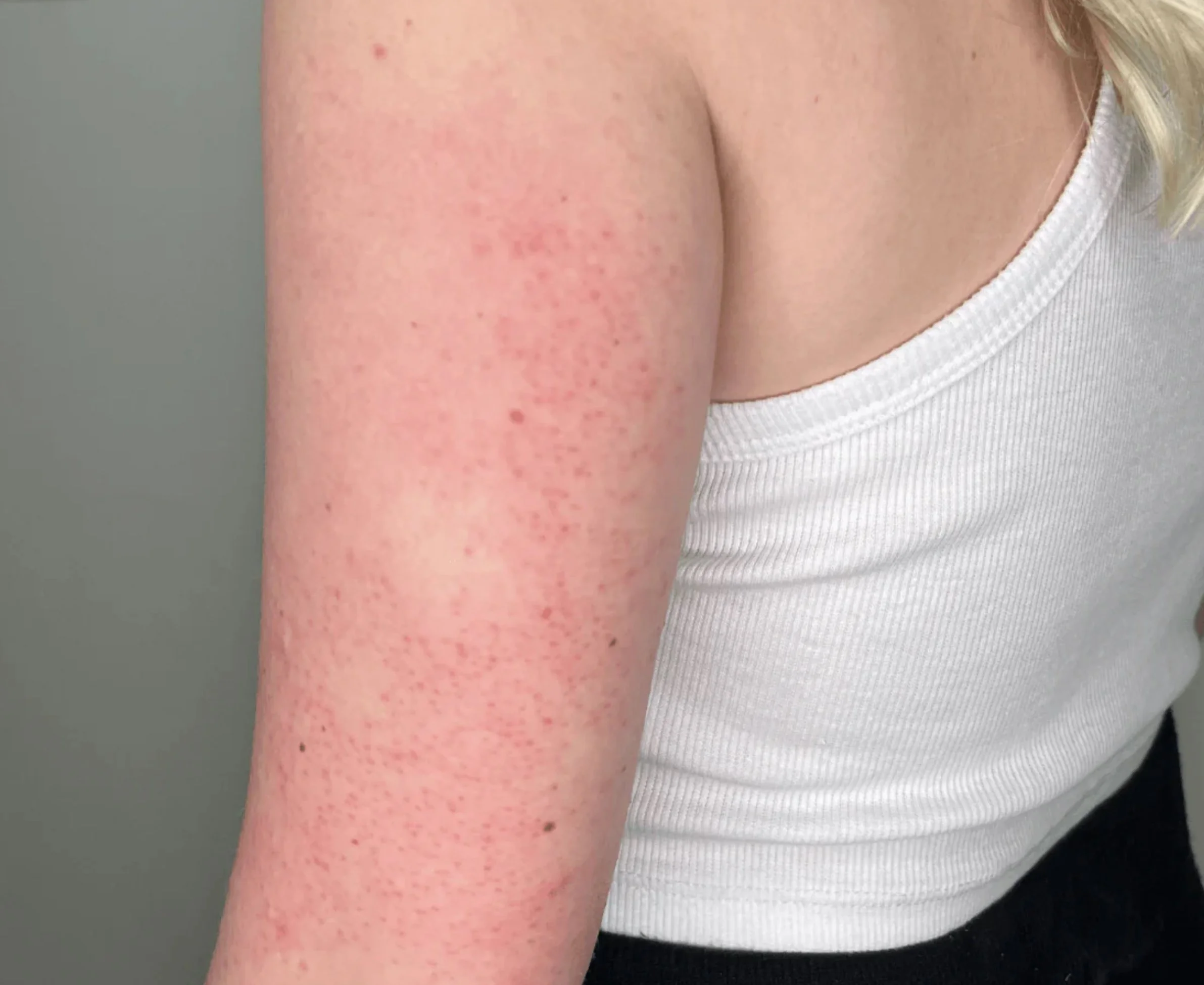 Close-up of a person's upper arm showing redness and small bumps, with part of a white tank top visible.
