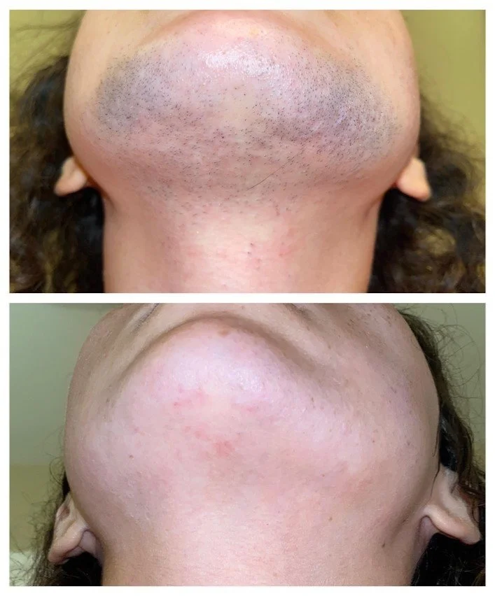 Before and after images of a person's chin and neck area showing significant reduction in hair and skin redness after treatment.