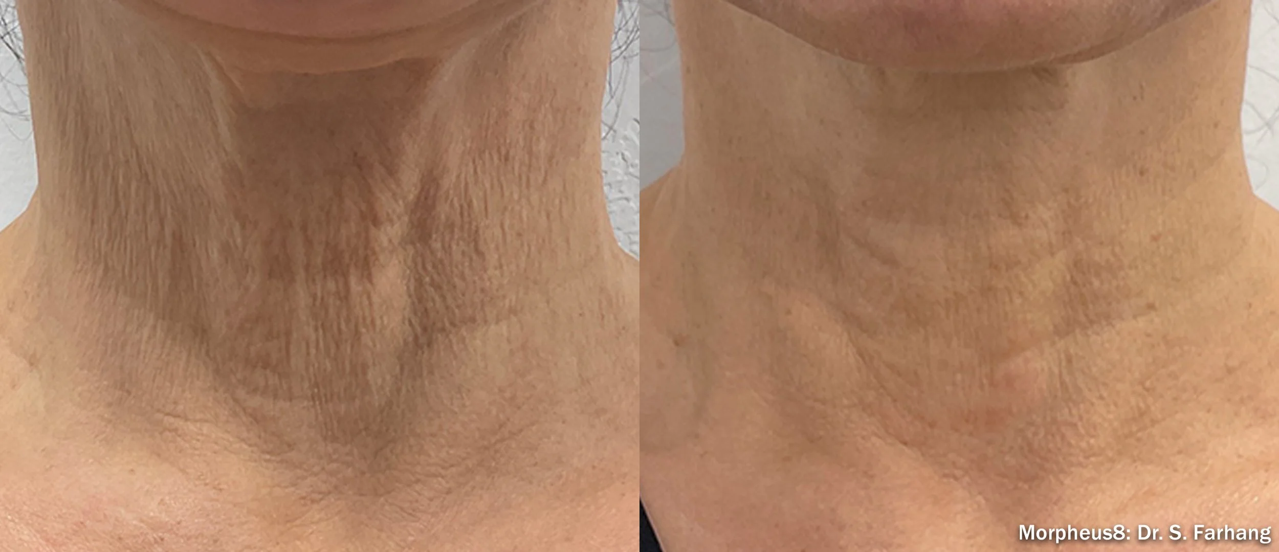 Comparison image showing a person's neck before and after skin treatment, with smoother and tighter skin after Morpheus8 radiofrequency microneedling by InMode treatment.