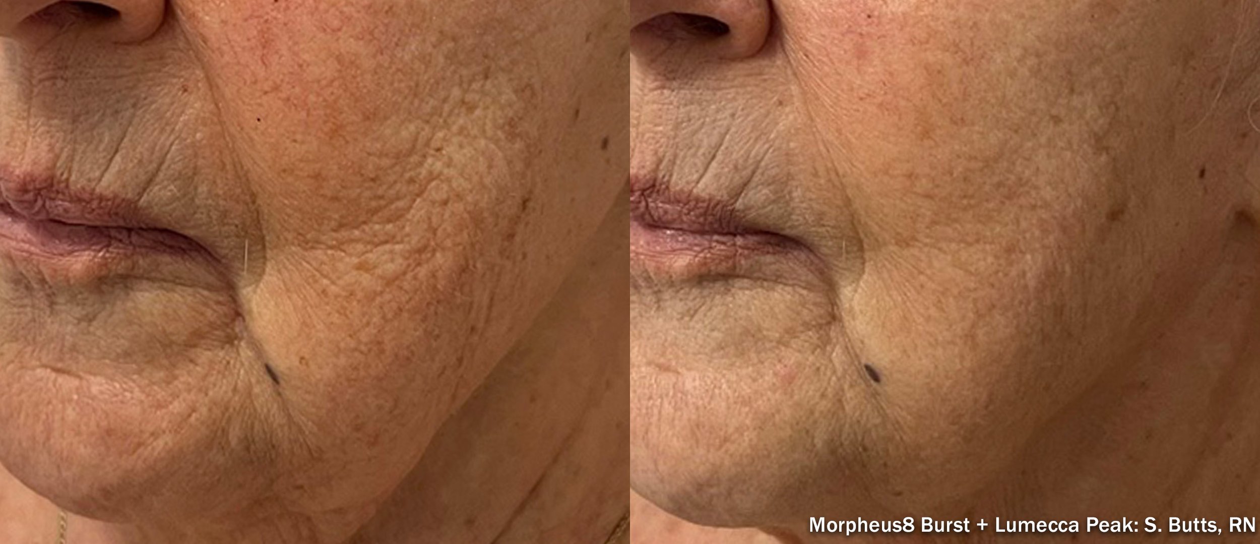 Close-up comparison of skin before and after Morpheus8 radiofrequency microneedling by InMode treatment, showing reduced wrinkles and improved skin texture.
