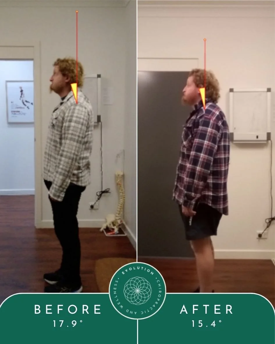 Well done, Jake! 💚🧡⁠
⁠
--------⁠
⁠
These before-and-after images show the results of a tailored chiropractic care plan, which included regular chiropractic adjustments over a three-month period.