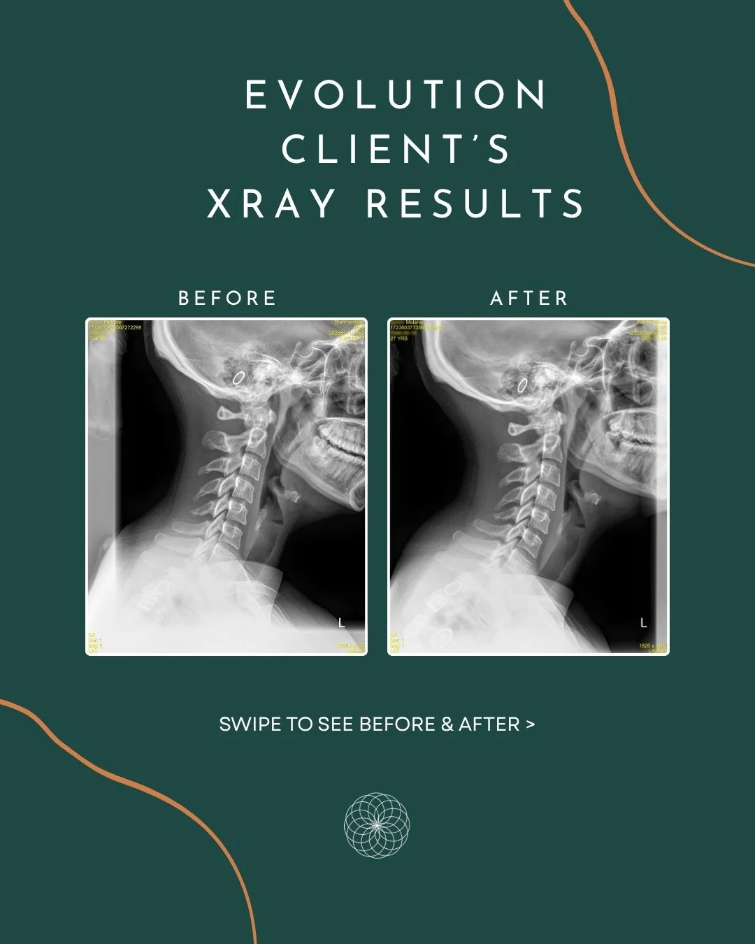 We love healthy curves! Look at this beautiful neck curve progress 1 year later! 🙌