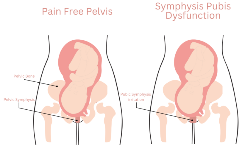 Pelvic Pain after Pregnancy — Pelvic Pain Foundation of Australia