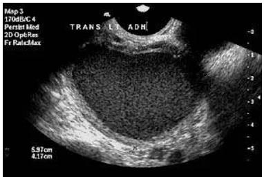 Ultrasound image showing a transverse view of the pelvic area, with measurements of approximately 5.97 cm and 4.17 cm.