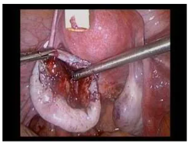 Laparoscopic surgical procedure.