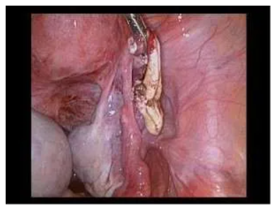Close-up of a laparoscopic surgical procedure for endometriosis removal.