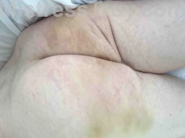 Cane marks 6 days later