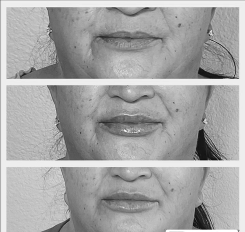 Before and After Dermal Filler Result 1