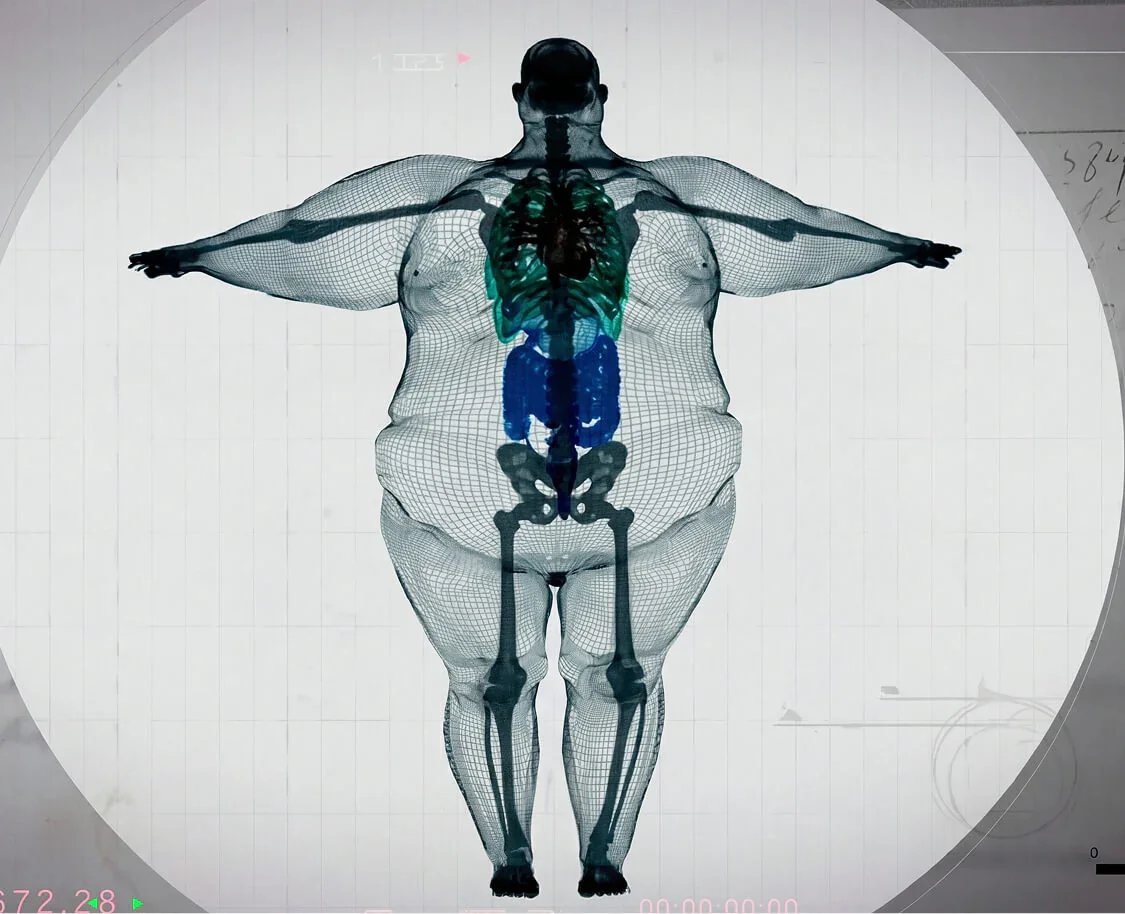 The “Big-Boned” Myth: Why Bone Structure Isn’t the Reason for Extra Weight