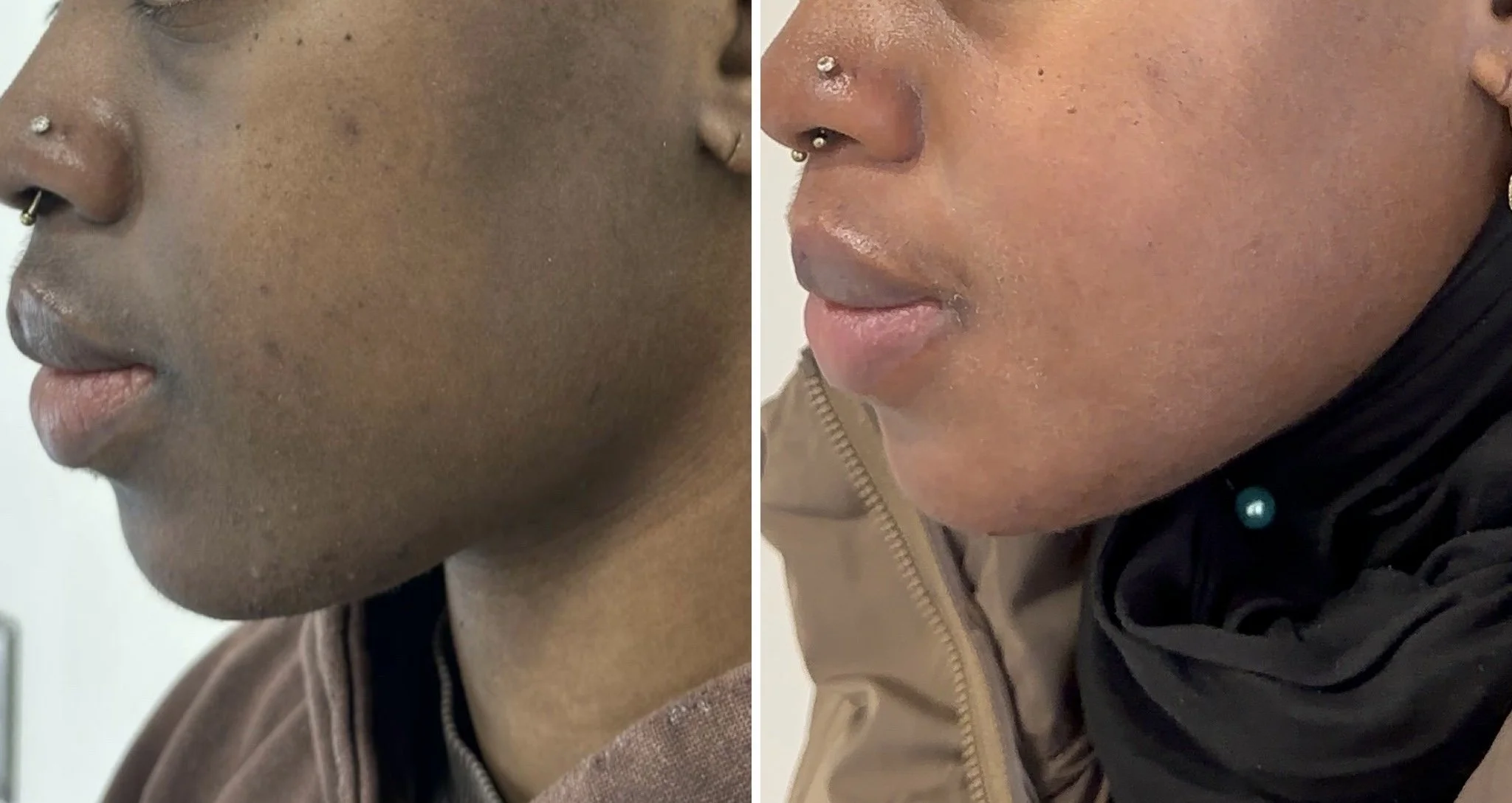 The GOAT for stubborn pigmentation.
