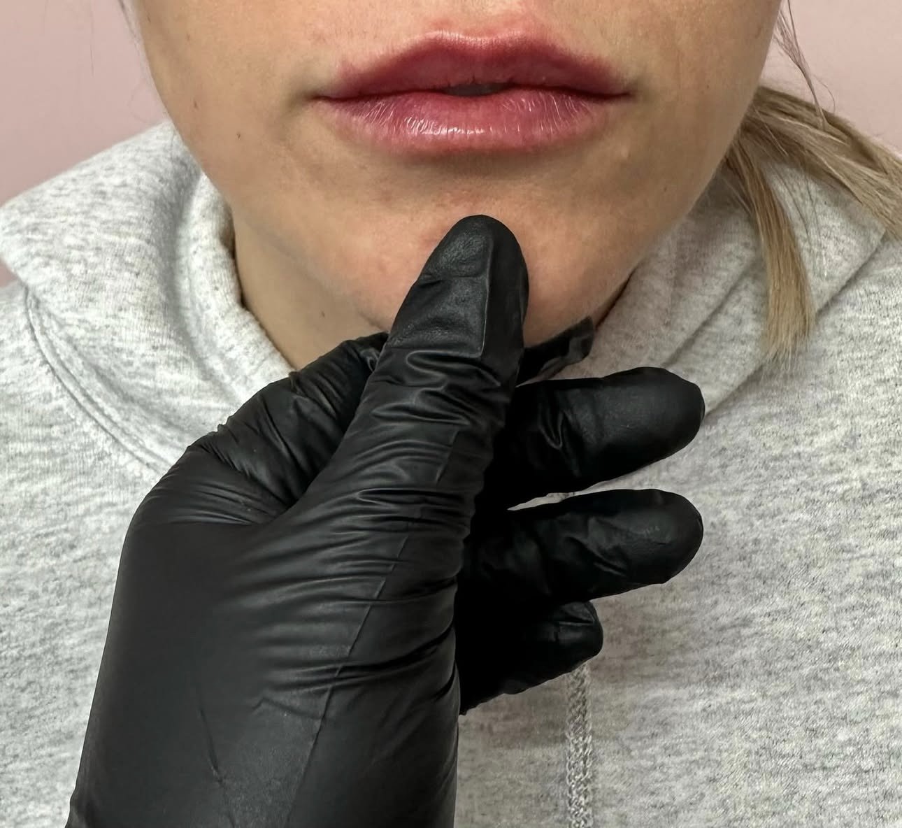 Person with lips highlighted wearing a gray hoodie, being examined with a black-gloved hand touching their chin.