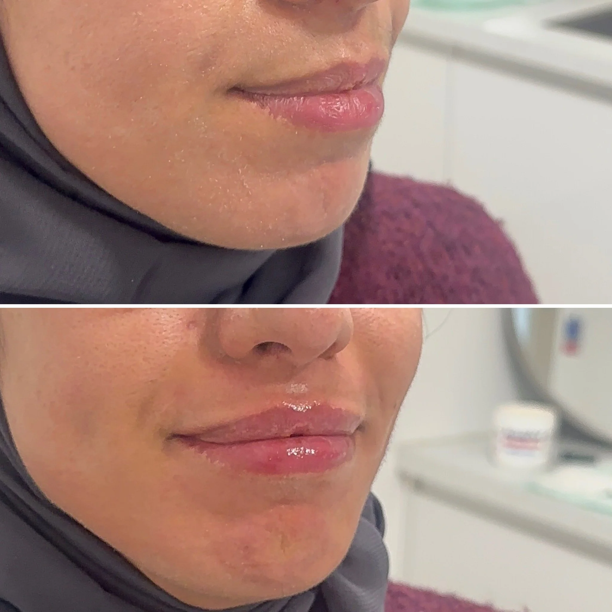 Close-up of a woman's face showing her lips, nose, and part of her cheek, with a neutral background.