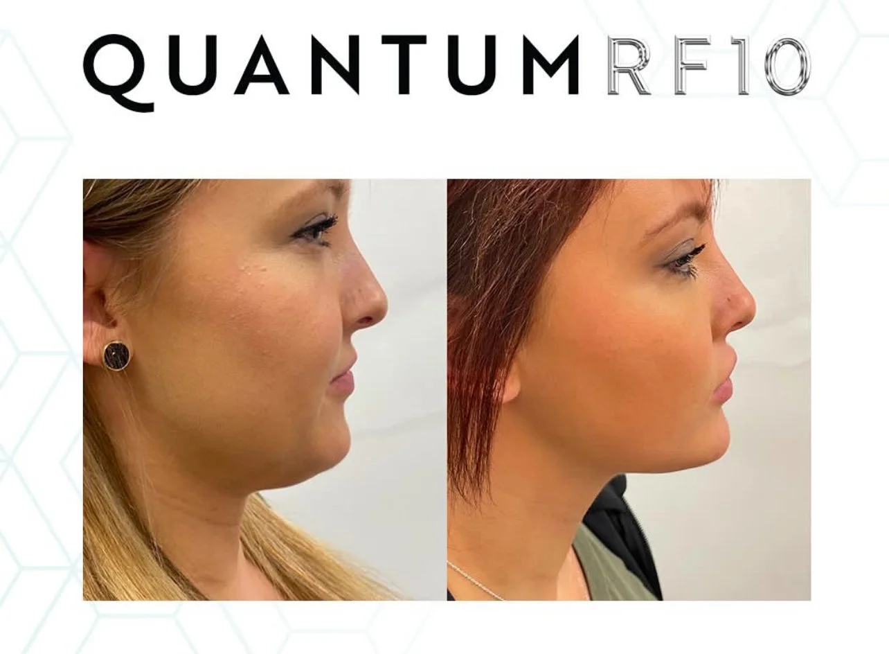 Quantum 10 - lower face - female-1.jpg