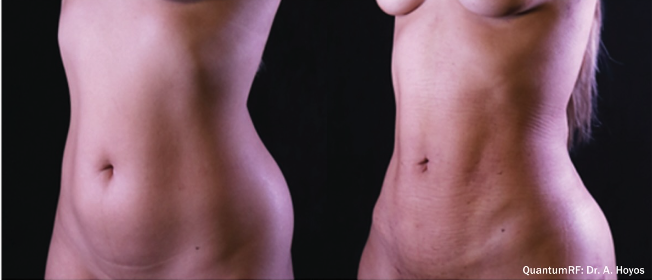 Quantum - abdomen - female.png