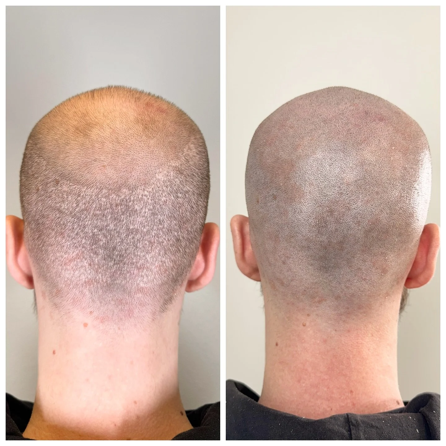 Scalp pigmentation, udf&oslash;res nu i SheLicious af @primapmu

Dette er fra FUE ar.
Den metode er den nyeste metode indenfor h&aring;rtransplantation som efterlader disse enkelte ar i nakken.

Kunden er en af mange som oplever at h&aring;rtransplan