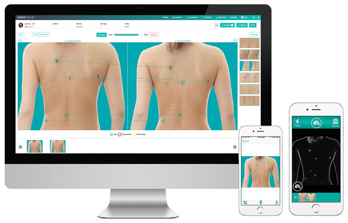 Screens from Dermengine skin cancer software showing front and back images of a person's upper body with marked spots for skin analysis, displayed on a desktop monitor and two smartphones.
