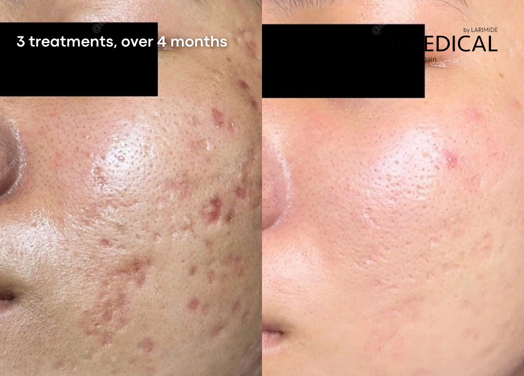 CLARITY PEEL + AQUA PEEL + RESTORE PEEL