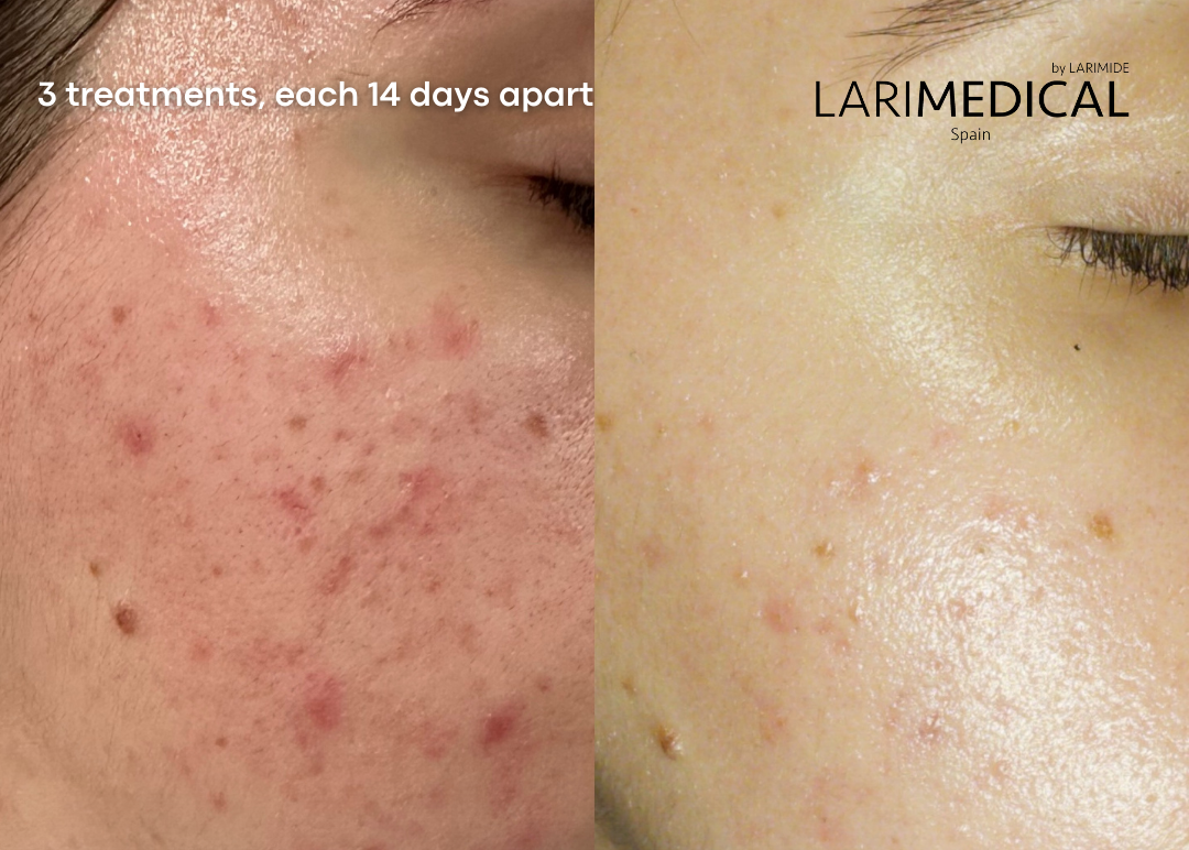 CLARITY PEEL + AQUA PEEL + RESTORE PEEL