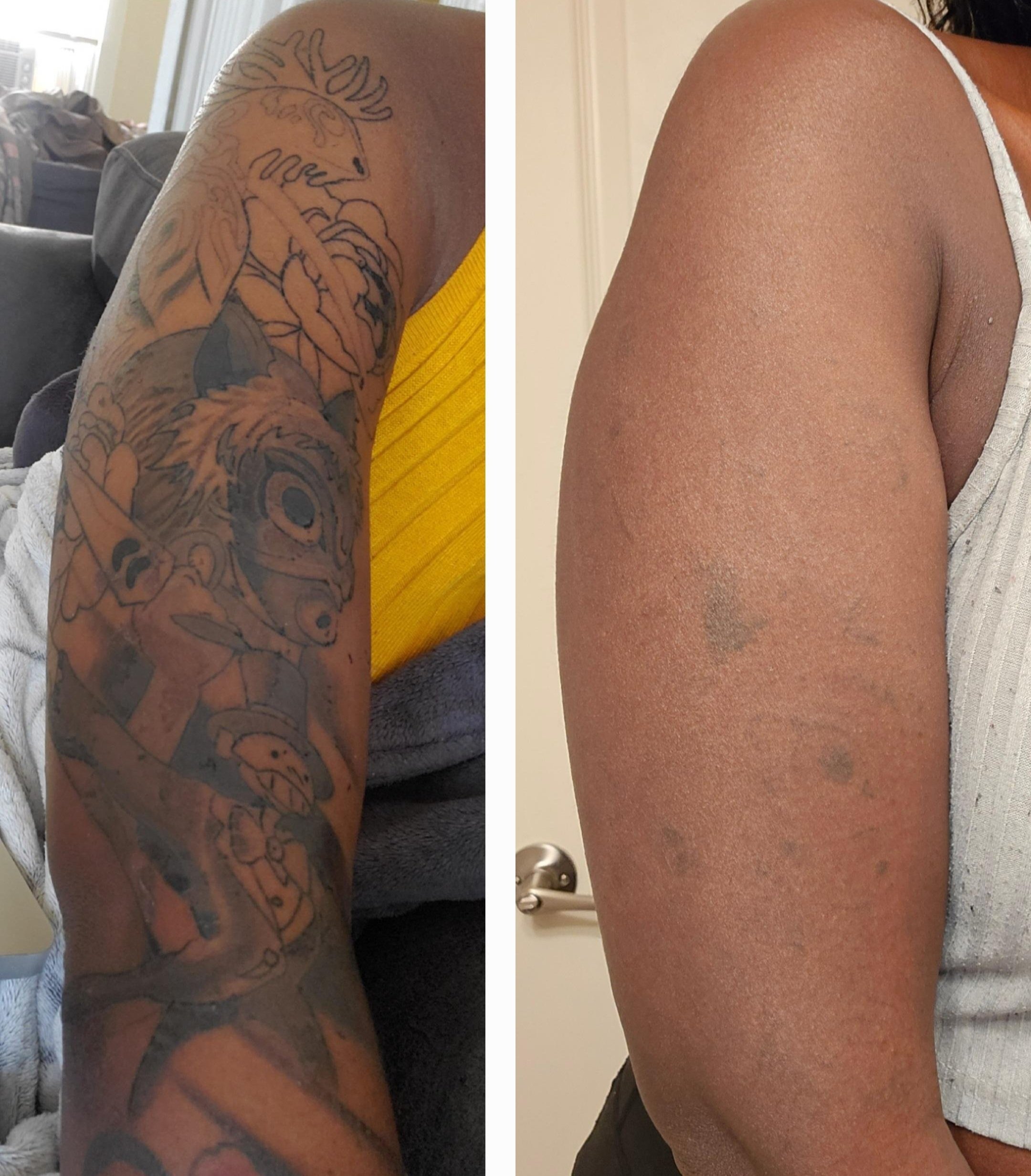 Comparison of arm tattoo before and after removal treatment