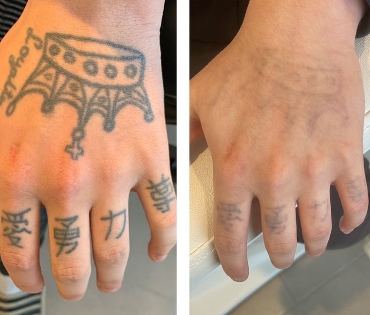 Two hands comparing tattoo removal progress. The left-hand image shows prominent hand tattoos with symbols and text. The right-hand image shows faded tattoos on a similar hand, indicating tattoo removal treatment.