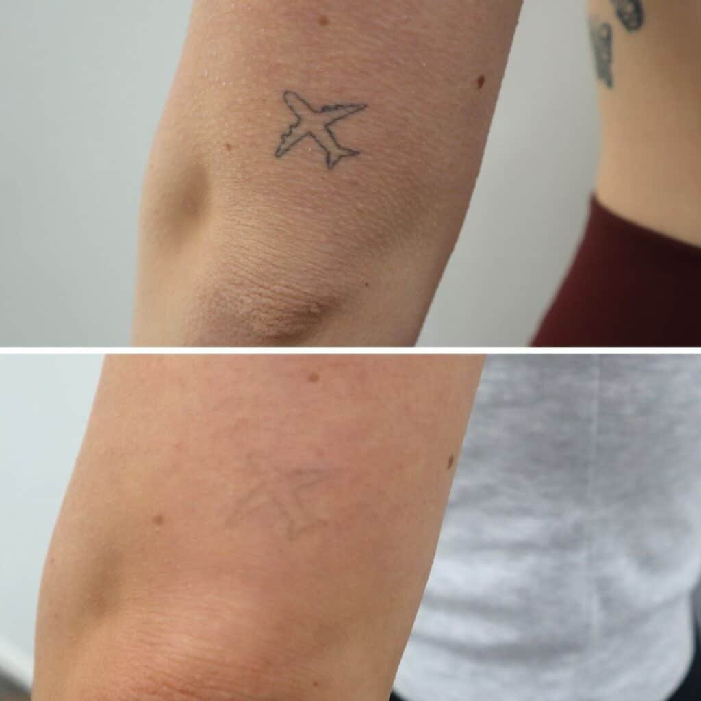 Before and after comparison of a small airplane tattoo; the top image shows a clearer tattoo, and the bottom image shows a faded tattoo.