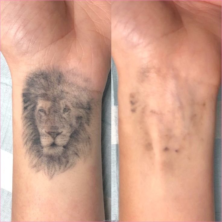 Before and after tattoo removal on wrist