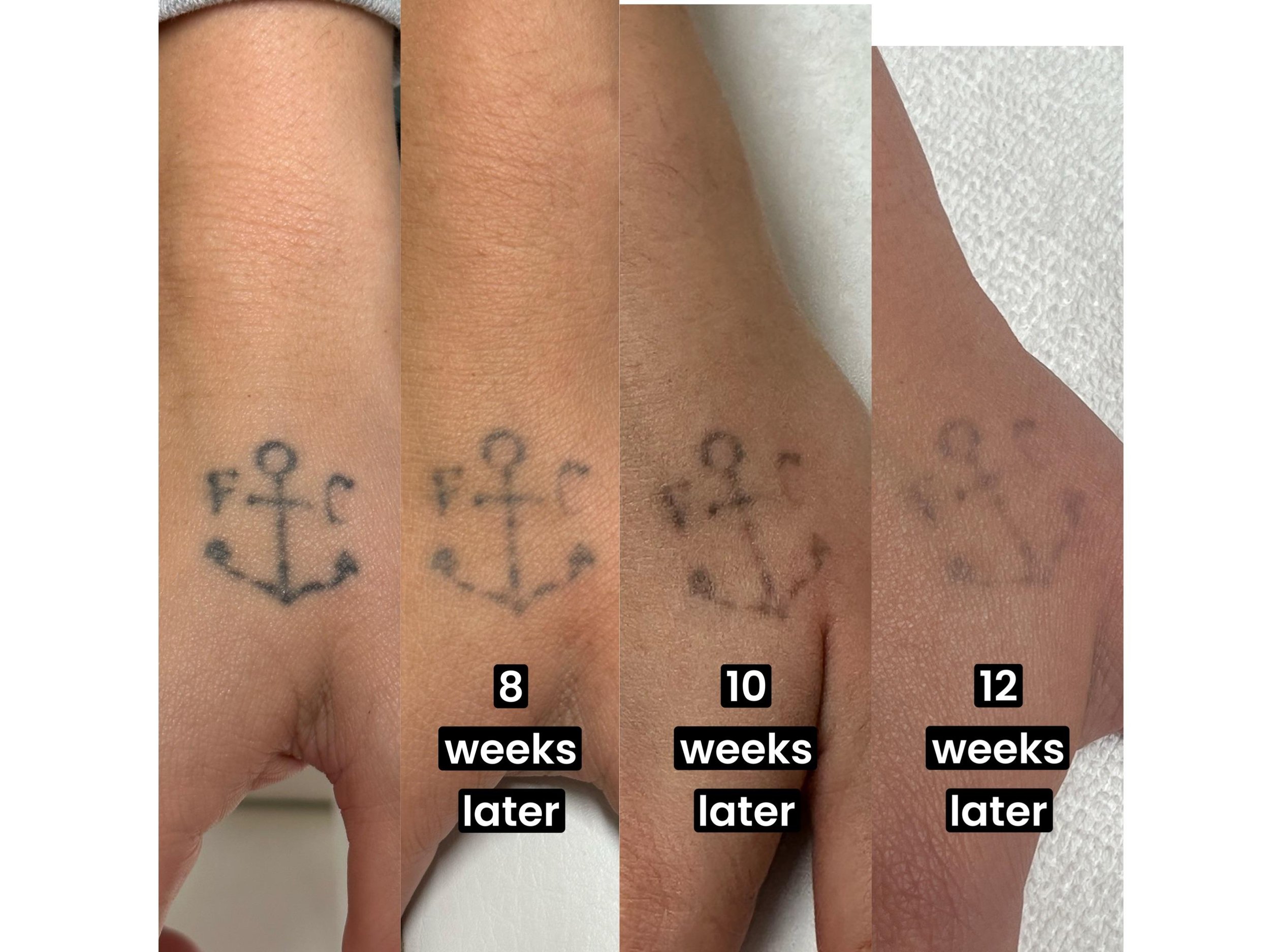Progression of anchor tattoo fading over 8, 10, and 12 weeks
