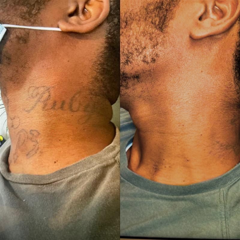 Side-by-side comparison of a person's neck; left image shows a neck tattoo, right image shows the area without the tattoo.