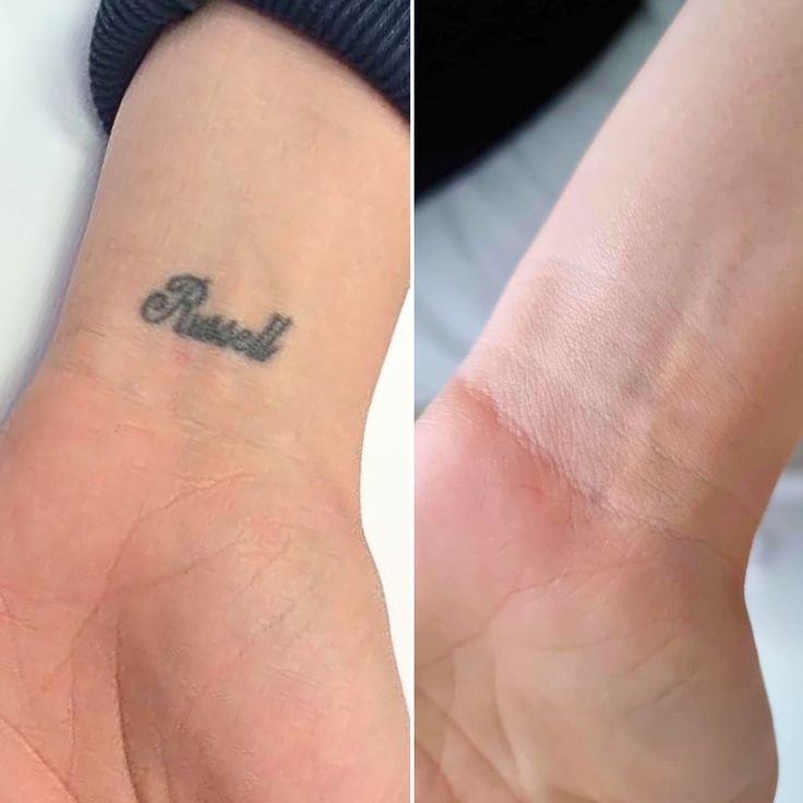 The tattoo appears dark and clearly visible, but….jpg