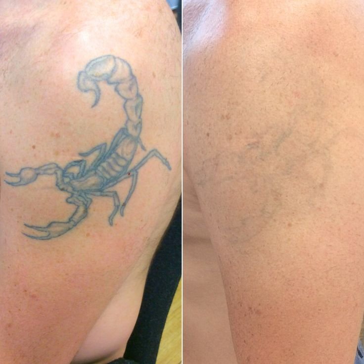 Before and after tattoo removal comparison on upper arm with scorpion design.