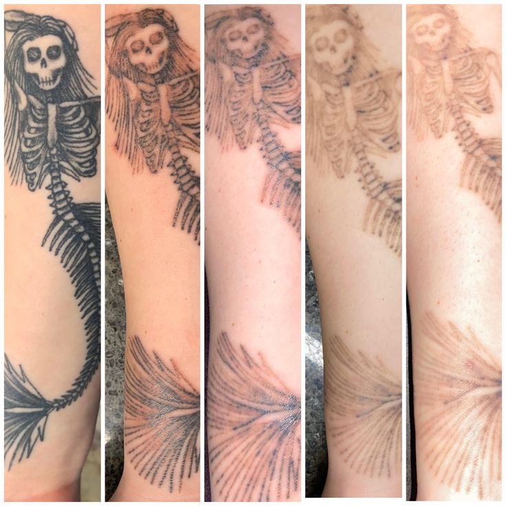 Tattoo of a skeleton mermaid fading over time, depicted in four stages on an arm.