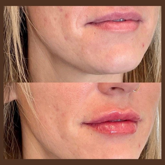 Before & After: Lip Injection