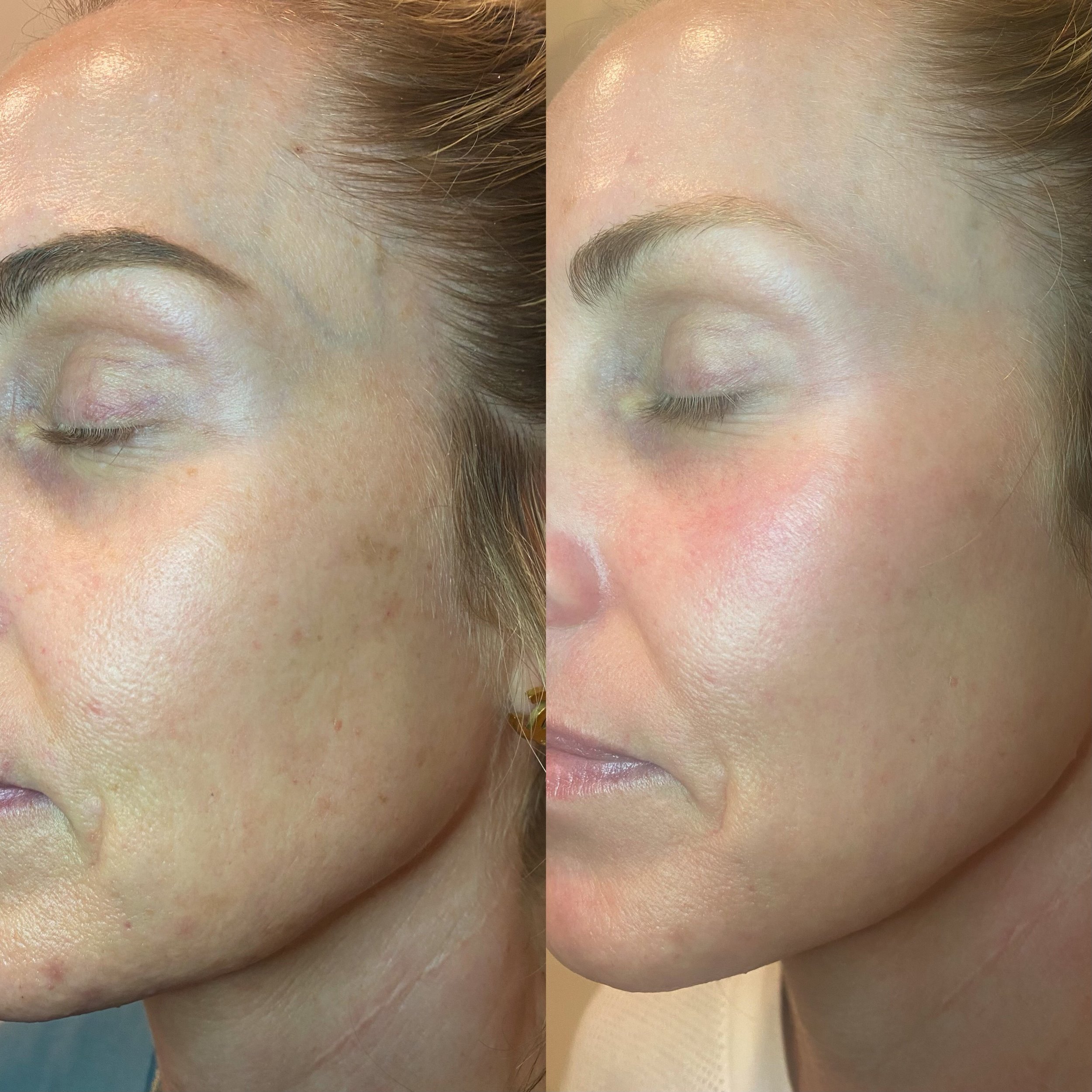Before & After: Skin Pen after 1 treatment