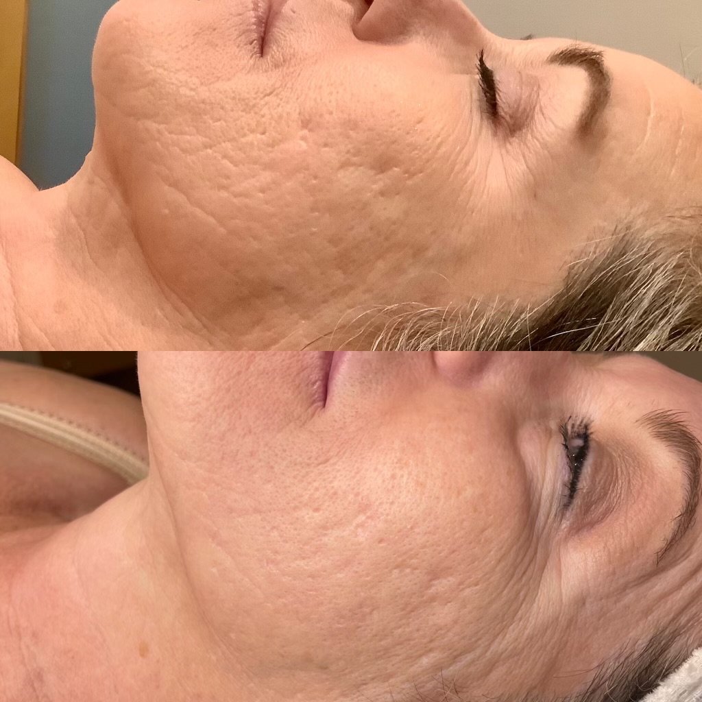 Before & After: CO2 Laser Resurfacing after 2 treatments