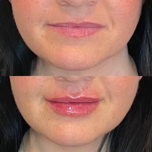 Before & After: Lip Injection