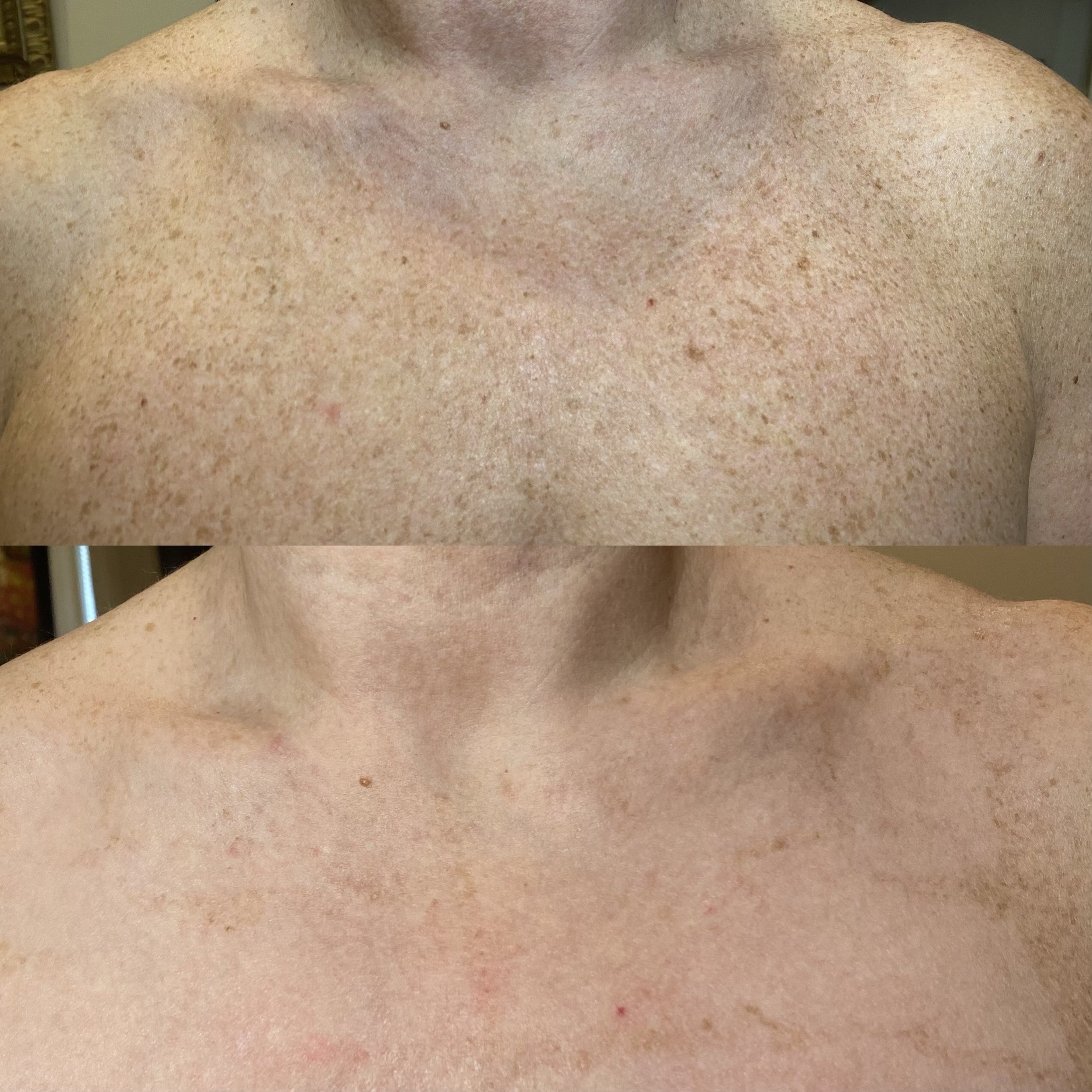 Before & After: Limelight after 2 treatments