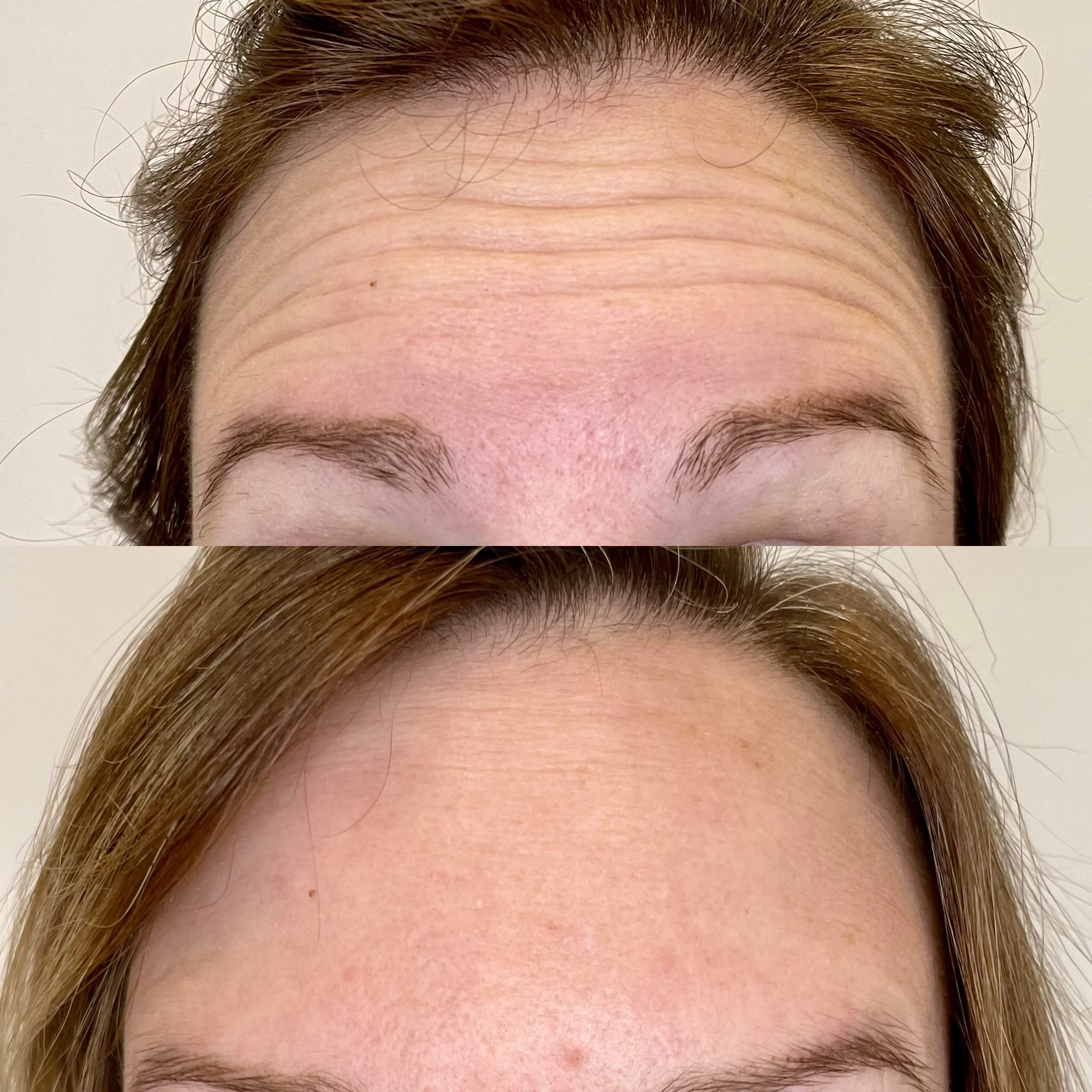 Before & After: Botox