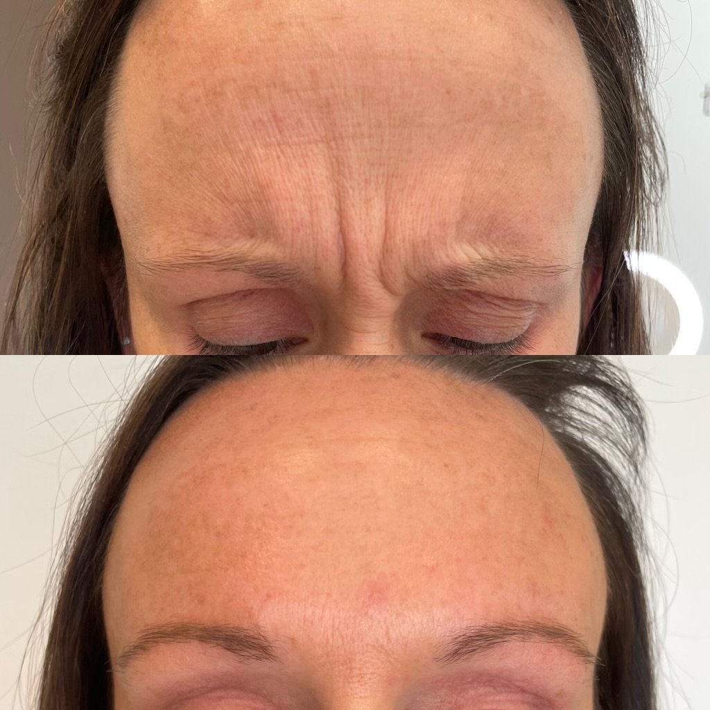 Before & After: Botox
