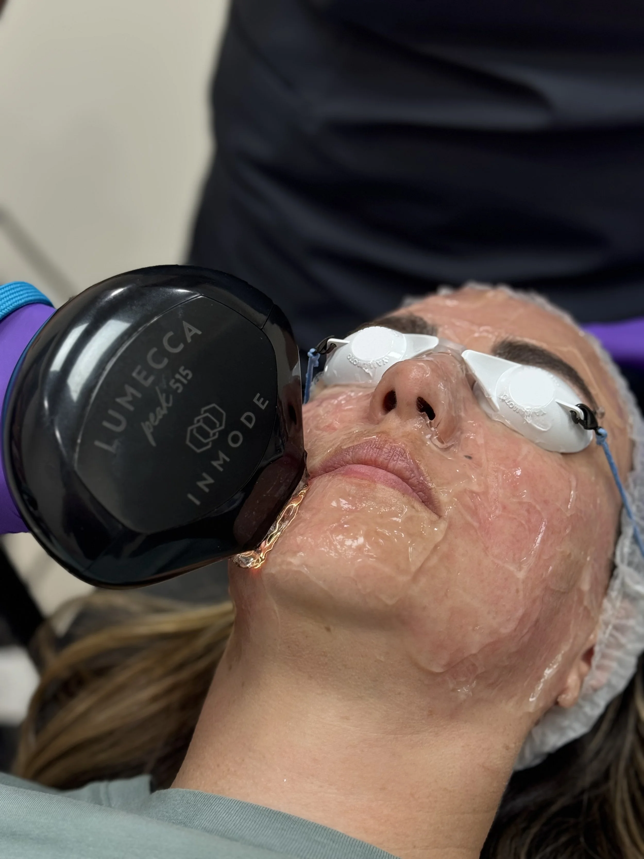 The Benefits of IPL