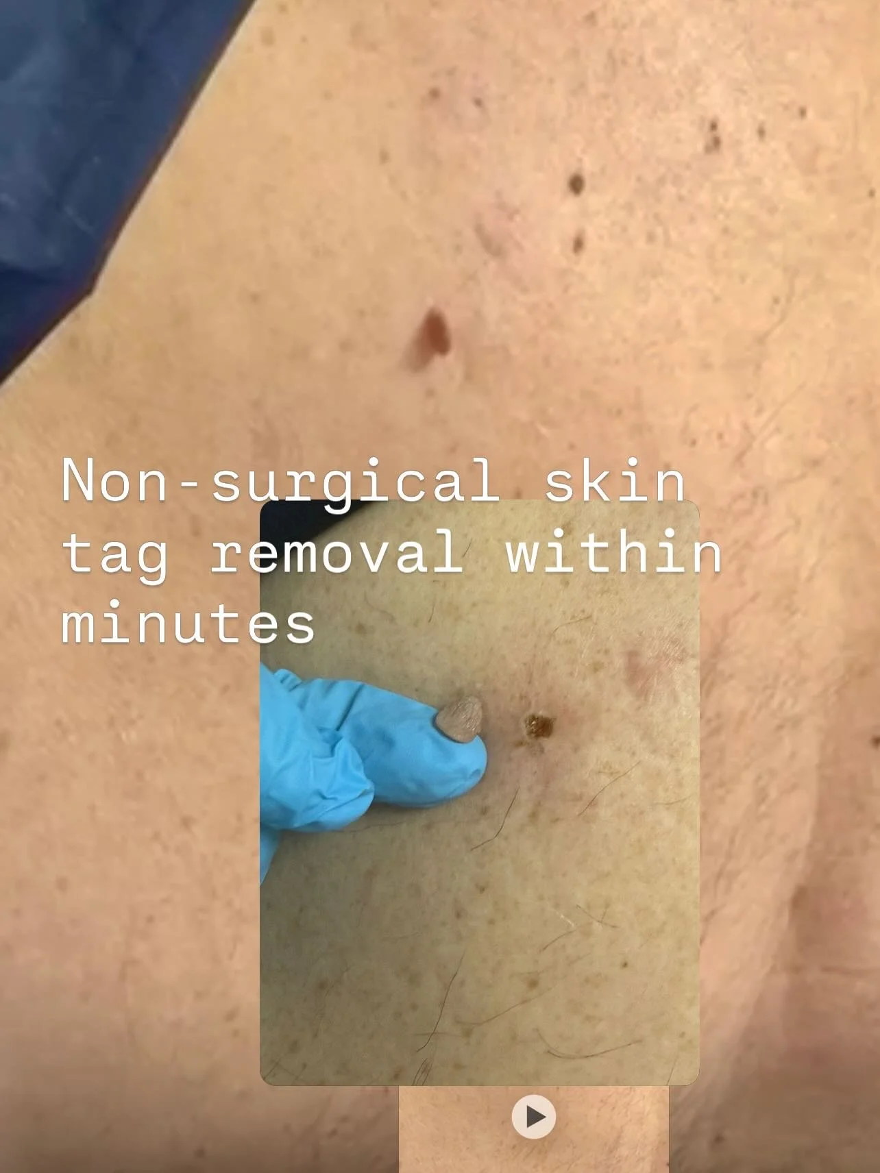 #non-surgical skin tags and warts removal#inquire to book