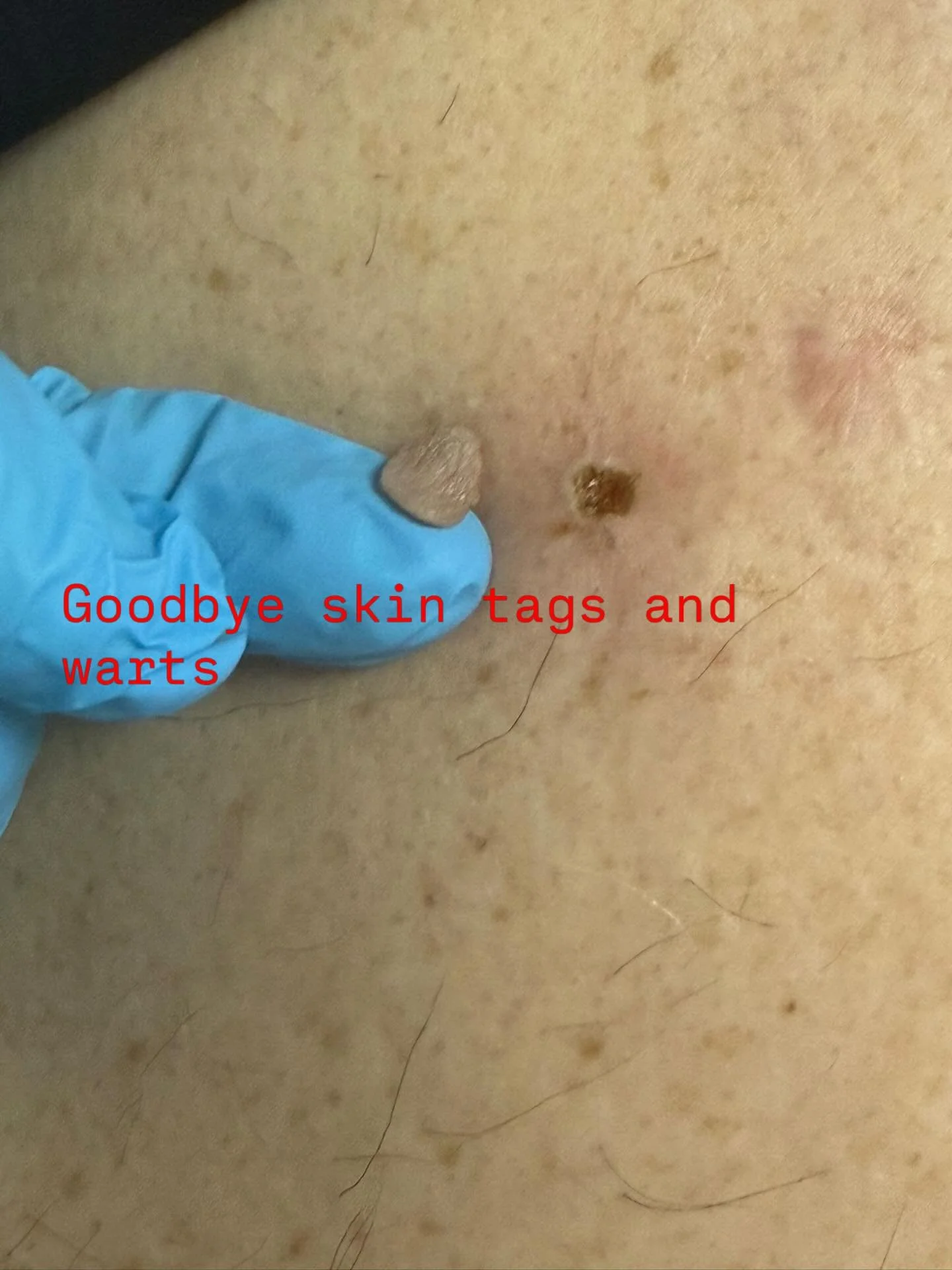 #skintagremoval #wartremoval #nonsurgicaltreatments#manchesteraesthetics