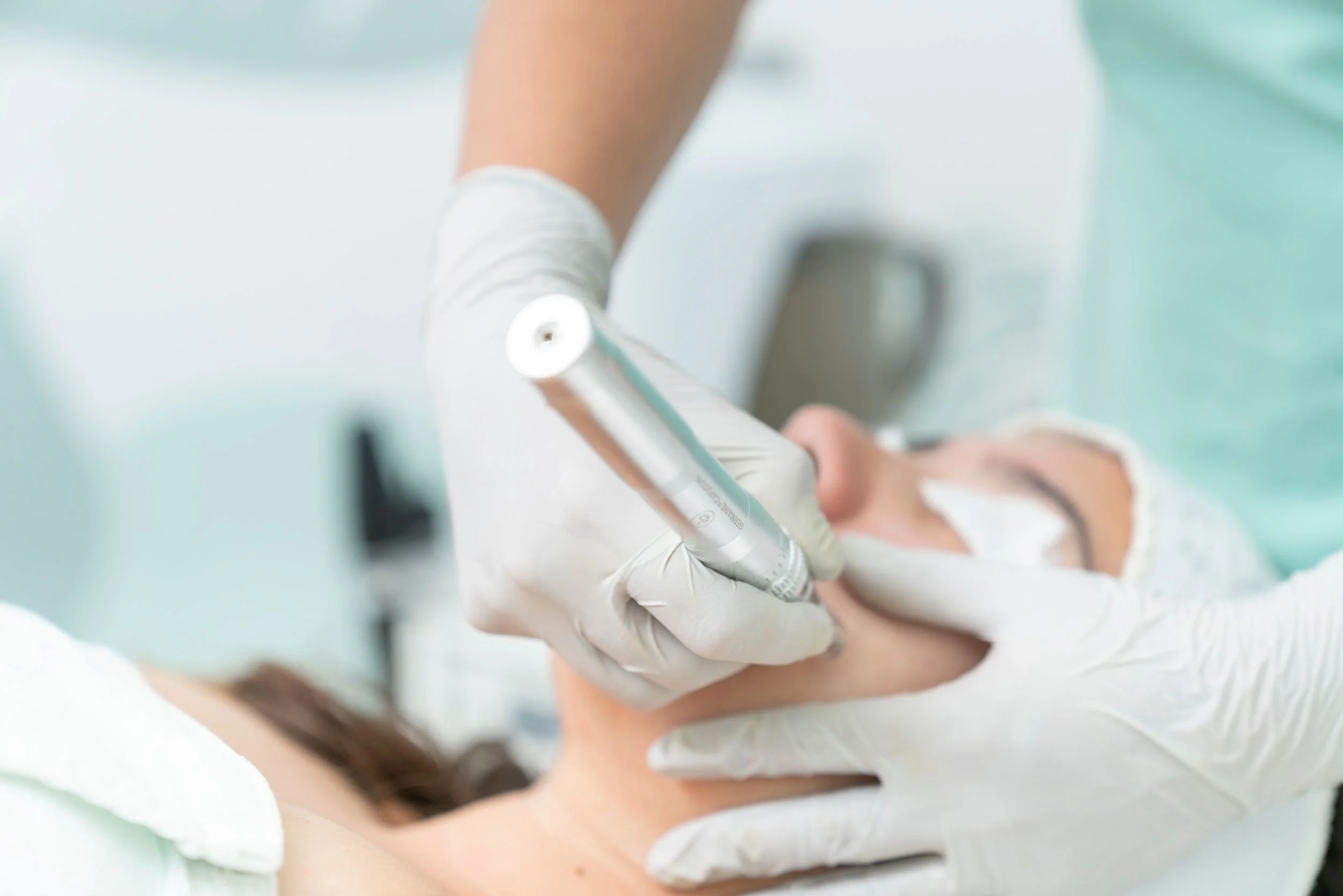 Microneedling for Acne Scars and Uneven Texture