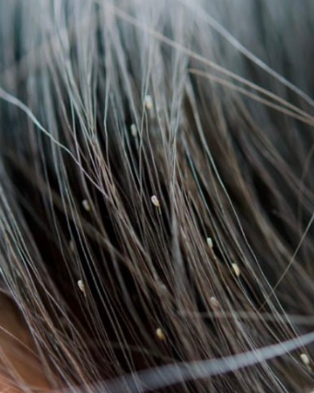 Lice Treatment Long Island